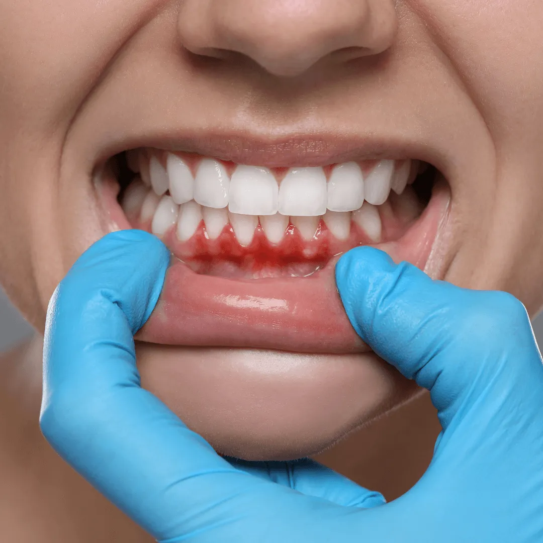 Gum Recession Treatment