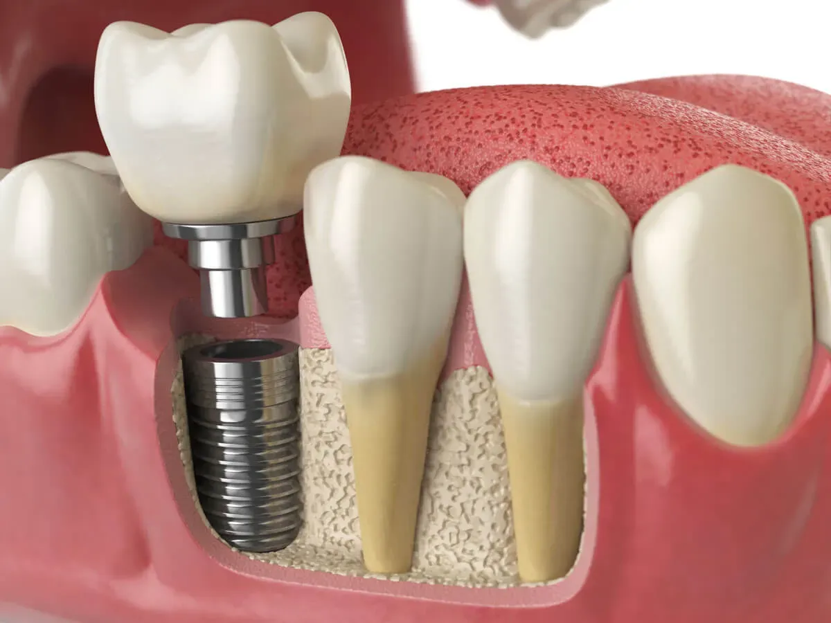Permanent Tooth Replacement