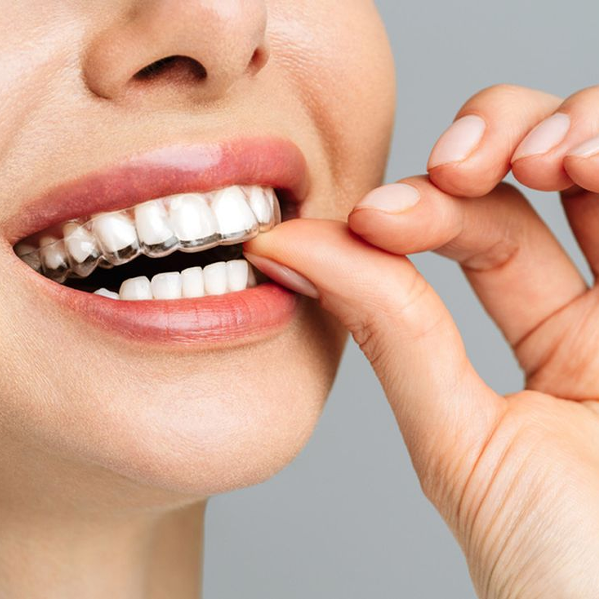 Promotion braces